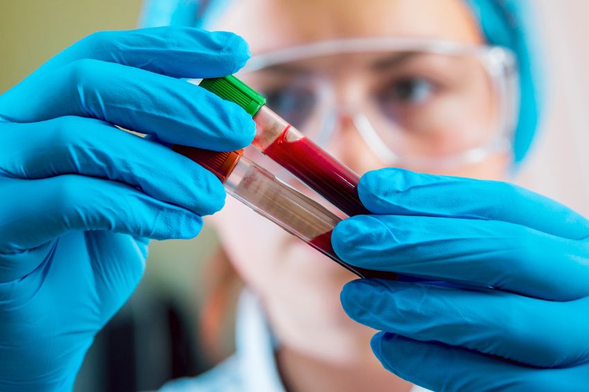 Exame de sangue pode prever risco de hipertensão pulmonar